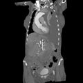 Aortic dissection (Radiopaedia 68763-78691 B 10).jpeg