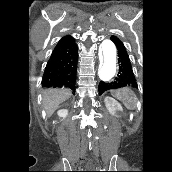 File:Aortic dissection - DeBakey Type I-Stanford A (Radiopaedia 79863-93115 B 32).jpg