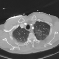 Aortic dissection - DeBakey type II (Radiopaedia 64302-73082 Axial lung window 12).png