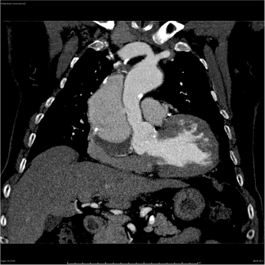 Aortic dissection - Stanford type A (Radiopaedia 26183-26315 A 19).jpg