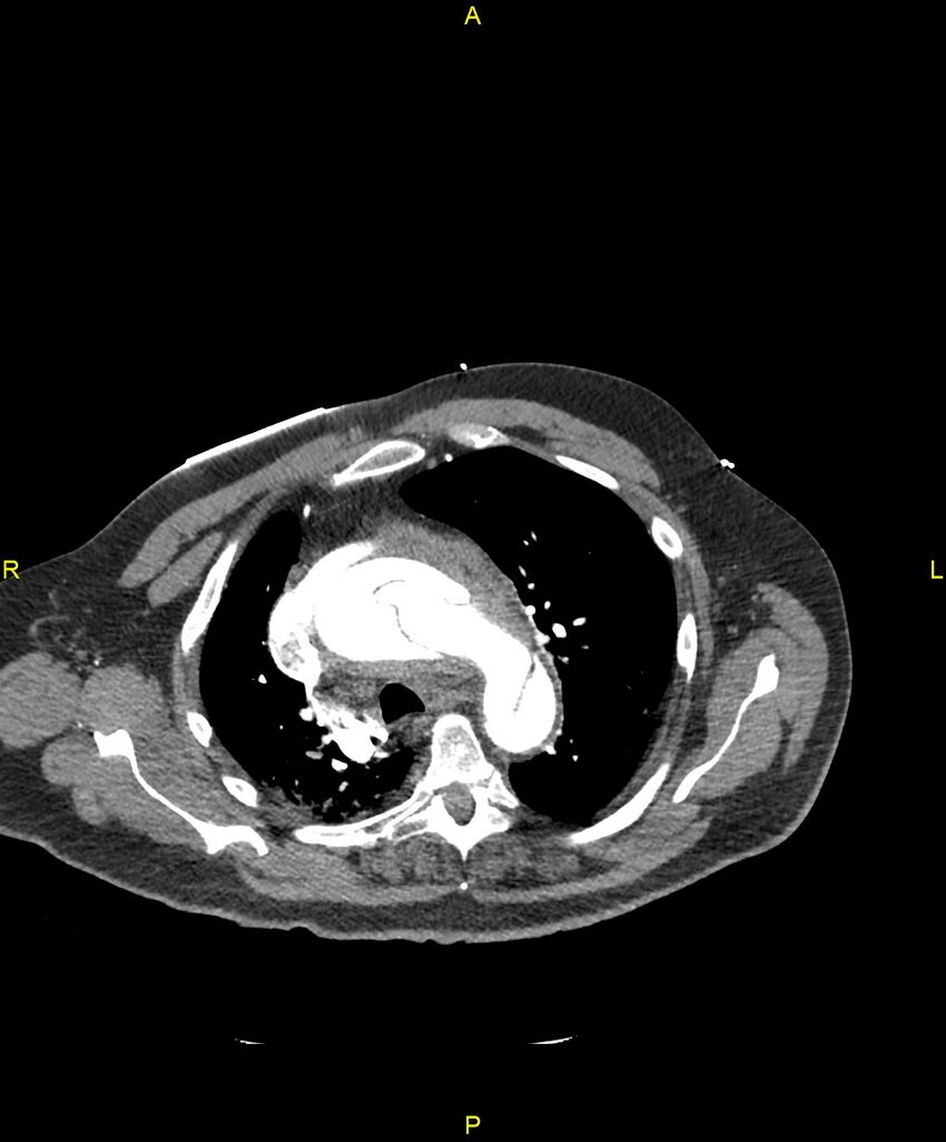 Aortic rupture (Radiopaedia 88822-105594 B 75).jpg