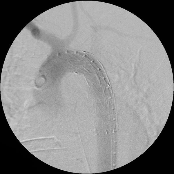 File:Aortic transection and subclavian steal (Radiopaedia 8711-9517 Stent 7).jpg