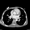 Aortopulmonary window, interrupted aortic arch and large PDA giving the descending aorta (Radiopaedia 35573-37074 B 45).jpg