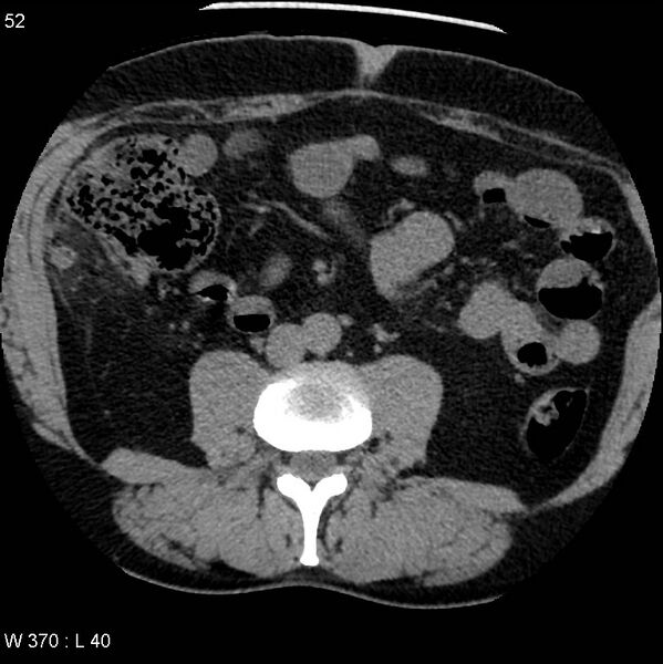File:Appendicitis (Radiopaedia 12510-12733 Axial non-contrast 19).jpg