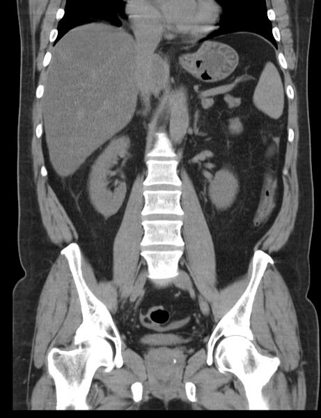 File:Appendicitis and giant appendicolith (Radiopaedia 80251-93588 Coronal non-contrast 27).jpg