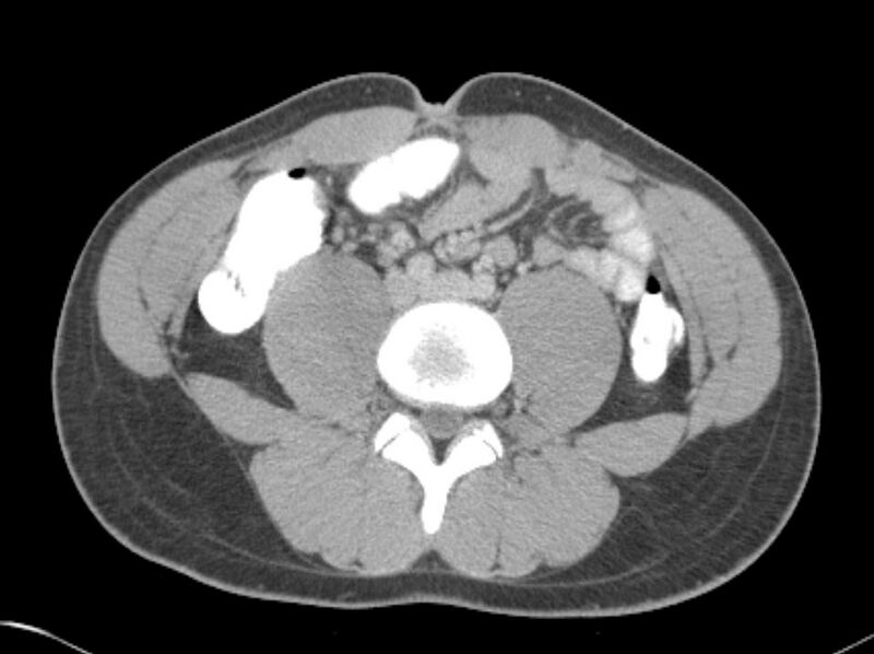 File:Appendicitis and incidental foregut duplication cyst (Radiopaedia 52962-58916 A 50).jpg