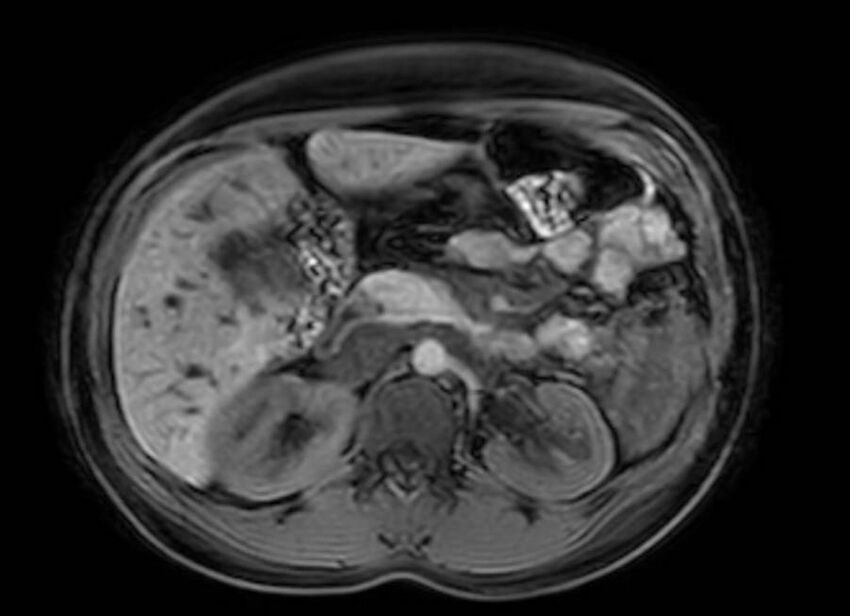 Appendicitis in gravida (MRI) (Radiopaedia 89433-106395 Axial DIXON 43).jpg