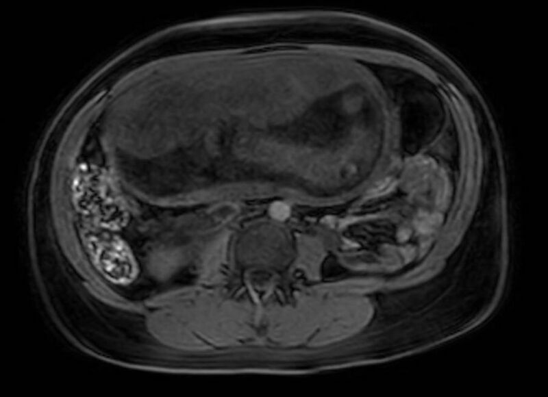 File:Appendicitis in gravida (MRI) (Radiopaedia 89433-106395 Axial DIXON 69).jpg