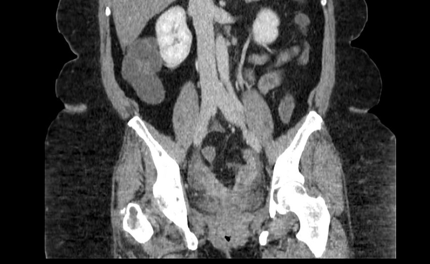 Appendix mucocele (Radiopaedia 41222-44033 B 50).jpg