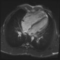 Arrhythmogenic right ventricular cardiomyopathy (Radiopaedia 57972-64966 A 25).jpg