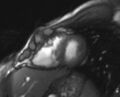 Arrhythmogenic right ventricular cardiomyopathy (Radiopaedia 69564-79464 short axis cine 89).jpg