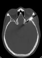 Arrow injury to the head (Radiopaedia 75266-86388 Axial bone window 67).jpg