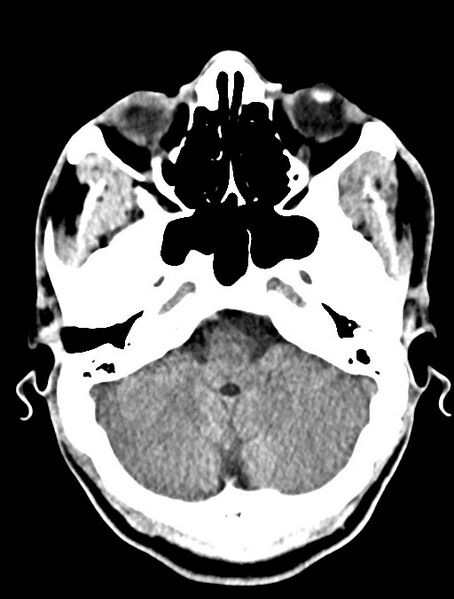 File:Arrow injury to the head (Radiopaedia 75266-86388 Axial non-contrast 10).jpg