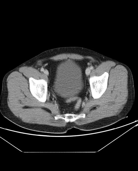File:Arterial occlusive mesenteric ischemia (Radiopaedia 84641-100054 A 107).jpg