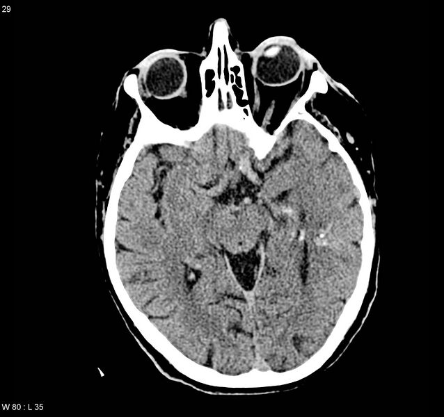 File:Arteriovenous malformation - cerebral (Radiopaedia 8172-9020 Axial non-contrast 8).jpg
