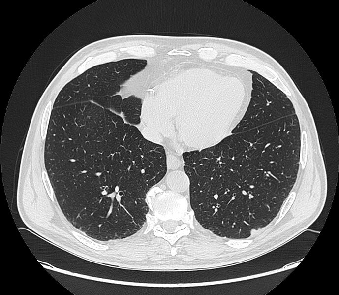 File:Asbestos pleural placques (Radiopaedia 57905-64872 Axial lung window 174).jpg