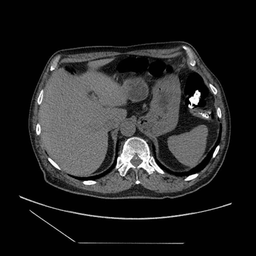 Asbestosis complicated by lung cancer (Radiopaedia 45834-50116 Axial non-contrast 62).jpg