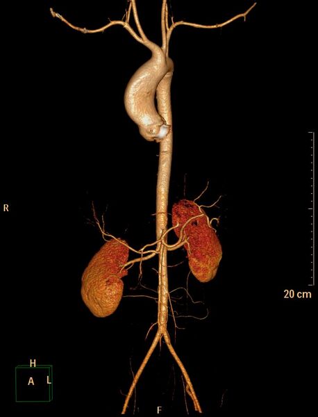 File:Ascending aortic pseudoaneurysm (Radiopaedia 28638-28910 D 34).jpg