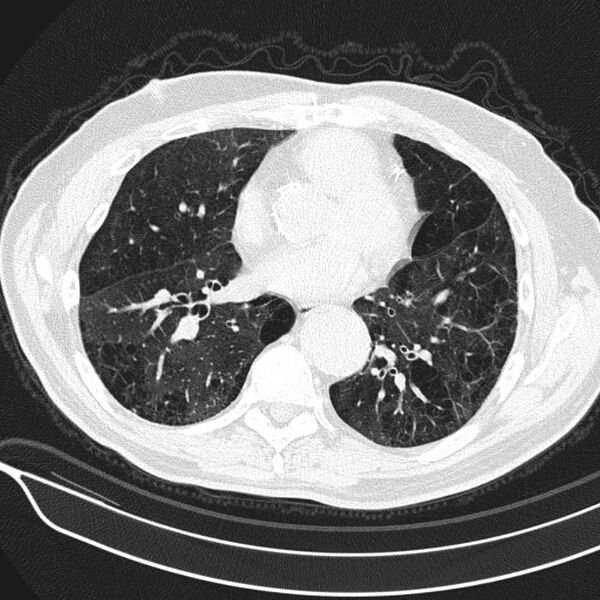 File:Aspergilloma (Radiopaedia 24521-24804 Axial lung window 15).jpg