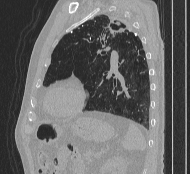 File:Aspergilloma (Radiopaedia 24521-24805 Sagittal lung window 1).png