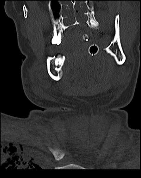 File:Atlanto-occipital dissociation - Traynelis type 1 (Radiopaedia 87570-103948 Coronal bone window 3).jpg