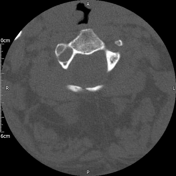 File:Atlas fracture with Currarino type A congenital defect (Radiopaedia 71747-82144 Axial bone window 58).jpg