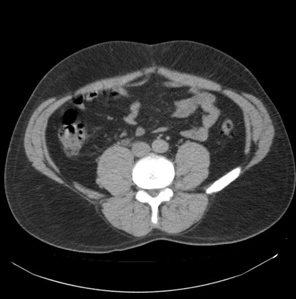 File:Atrophic kidney due to severe chronic obstructive hydronephrosis (Radiopaedia 40828-43474 Axial non-contrast 21).jpg