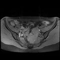Atypical deep infiltrating endometriosis (Radiopaedia 44470-48125 Axial T1 fat sat 8).jpg