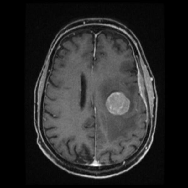 File:Atypical meningioma (Radiopaedia 45535-49629 Axial T1 C+ 46).jpg