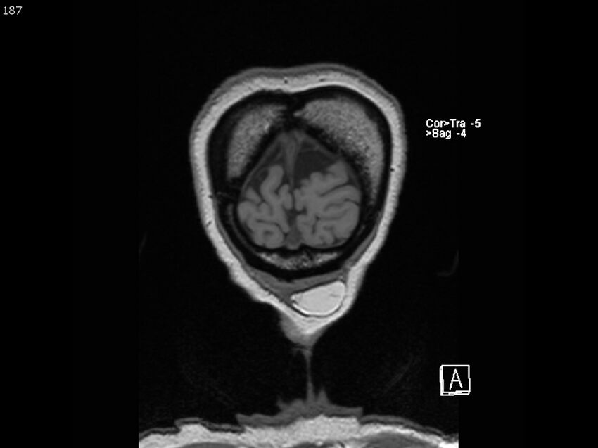 Atypical meningioma - intraosseous (Radiopaedia 64915-74572 Coronal T1 187).jpg