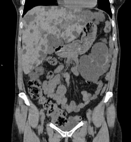 File:Autosomal dominant polycystic kidney disease (Radiopaedia 41918-44922 Coronal non-contrast 8).jpg
