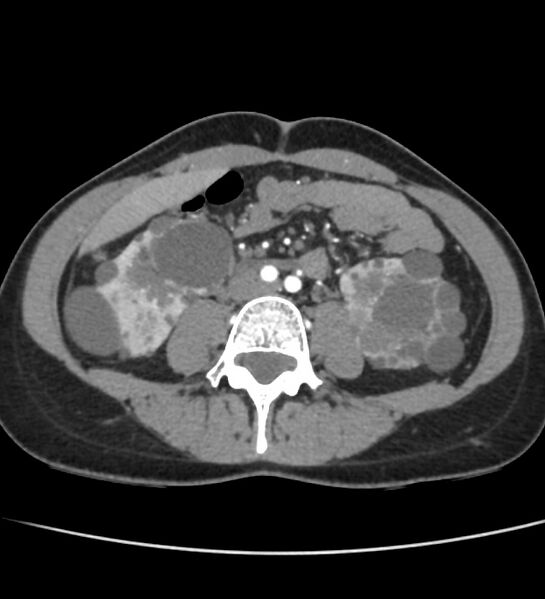 File:Autosomal dominant polycystic kidney disease - early onset (Radiopaedia 40734-43387 B 42).jpg