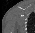 Avulsion fracture - greater tuberosity of humerus (Radiopaedia 71216-81514 Coronal bone window 56).jpg