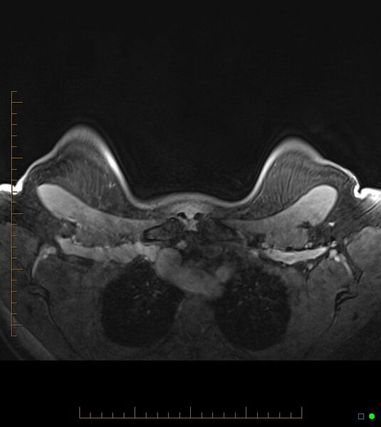 File:Axillary lymphadenopathy on breast MRI- yellow fever vaccination induced (Radiopaedia 19454-19483 Axial T1 C+ fat sat 8).jpg