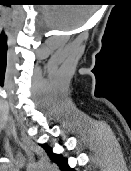 File:Axis peg fracture (type 3) and atlas lateral mass (type 4) fracture (Radiopaedia 37474-39324 D 26).png