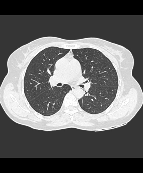 File:Azygos fissure and azygos lobe (Radiopaedia 41841-44832 Axial lung window 16).jpg