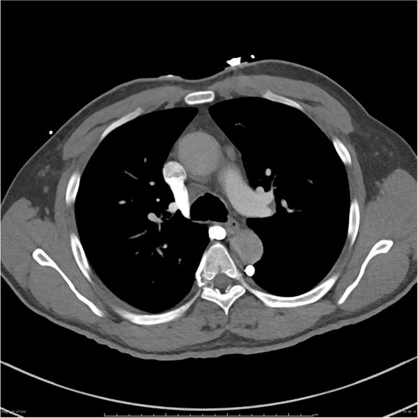 File:Azygos venous system anatomy (CT pulmonary angiography) (Radiopaedia 25928-26077 Axial C+ CTPA 31).jpg