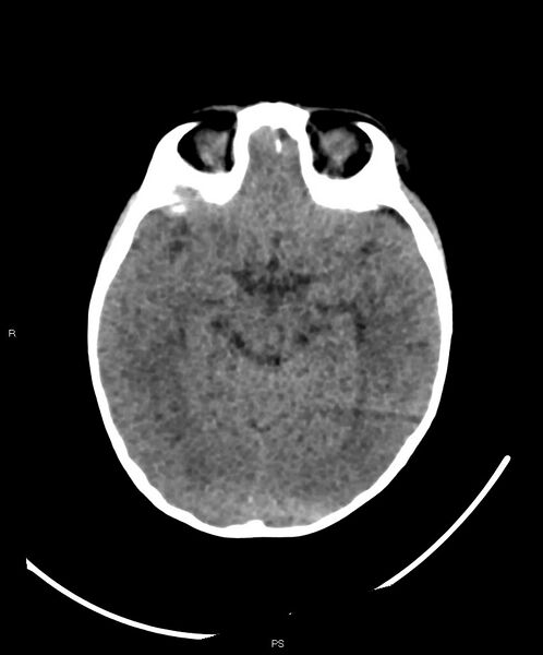 File:Basal ganglia and parenchymal ischemia (Radiopaedia 45818-50083 Axial non-contrast 27).jpg