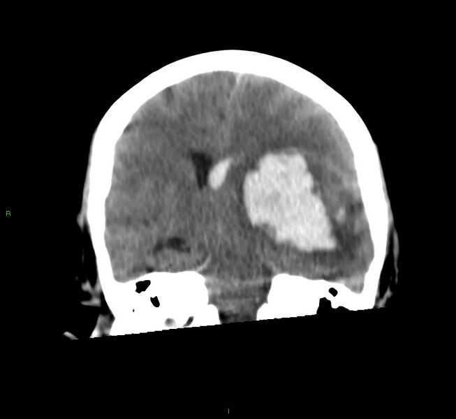 File:Basal ganglia hemorrhage (Radiopaedia 58759-65981 Coronal non-contrast 38).jpg