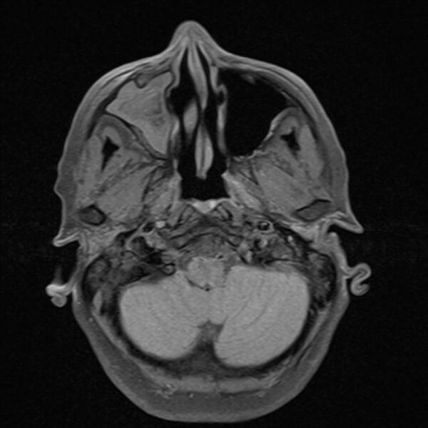 File:Base of skull chondrosarcoma (Radiopaedia 30410-31070 Axial T1 fat sat 4).jpg