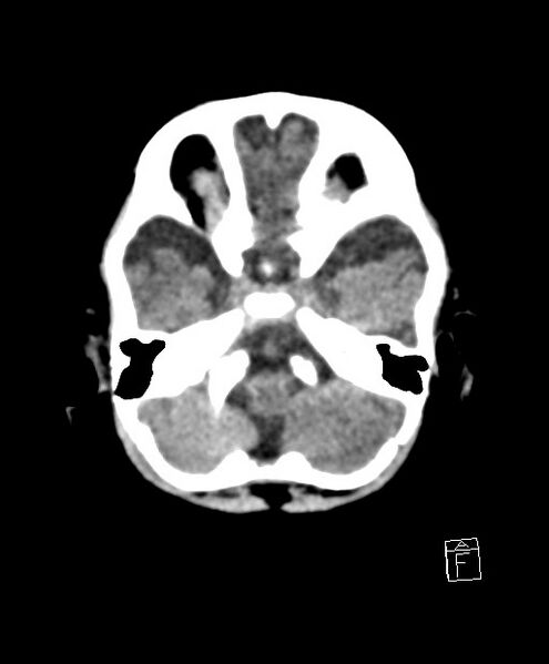 File:Benign enlargement of subarachnoid spaces in infancy (BESS) (Radiopaedia 87459-103795 Axial non-contrast 71).jpg