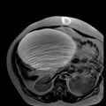 Benign seromucinous cystadenoma of the ovary (Radiopaedia 71065-81300 B 31).jpg