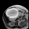 Benign seromucinous cystadenoma of the ovary (Radiopaedia 71065-81300 B 33).jpg