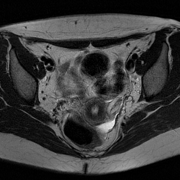 File:Bicornuate uterus (Radiopaedia 72135-82643 Axial T2 11).jpg