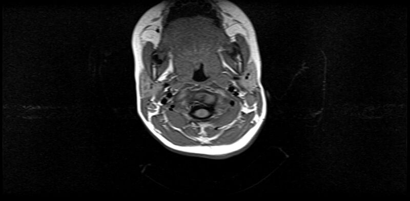 File:Bilateral Sprengel deformity with Klippel-Feil syndrome (Radiopaedia 66395-75650 Axial T1 7).jpg