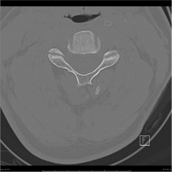 File:Bilateral cervical ribs (Radiopaedia 25868-26017 Axial bone window 22).jpg