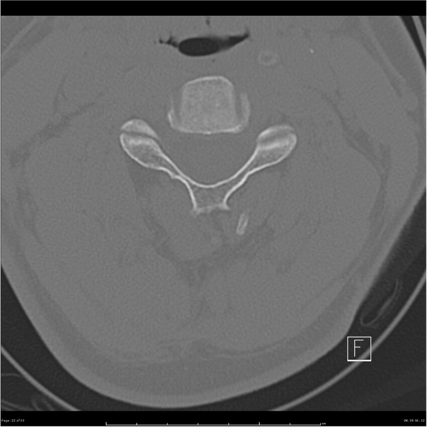 Bilateral cervical ribs (Radiopaedia 25868-26017 Axial bone window 22).jpg