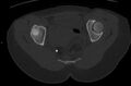 Bilateral mature cystic ovarian teratoma (Radiopaedia 88821-105592 Axial bone window 33).jpg