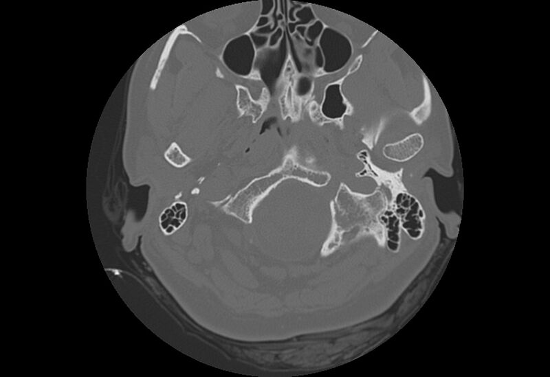 File:Bilateral otospongiosis (Radiopaedia 35447-36940 Axial bone window 3).jpg