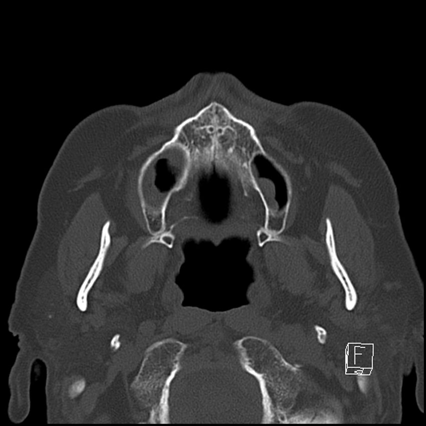 Bilateral palatine tonsilloliths on OPG and CT (Radiopaedia 75167-86247 Axial bone window 30).jpg